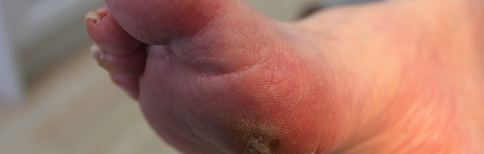 Chilblains
