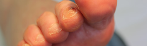 Claw Toes