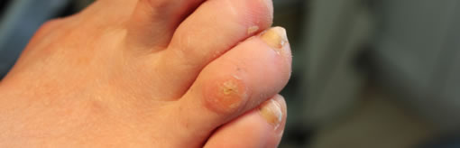 Hammer Toes