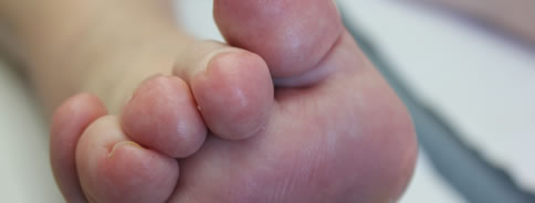 Retracted Toes