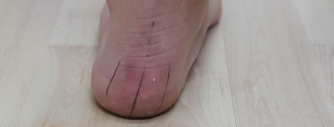 Severs Disease