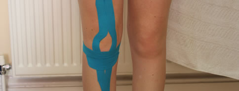 Shin Splints