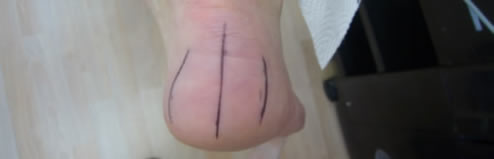 Assessing the ankle of the heel to the leg