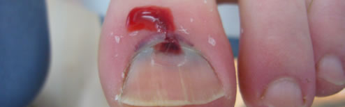 This large toe was treated without discomfort to the patient by draining blood which had become trapped under the nail as a result of dropping a dinner plate on to her toe