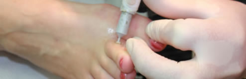 Cryosurgery