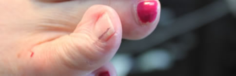 Nail Surgery