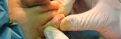 Nail Surgery