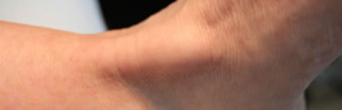 Tendon Injury
